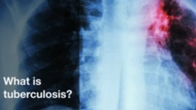 Tuberculosis Clinical Guide: Symptoms, Diagnosis & Updated Treatment Regimens
