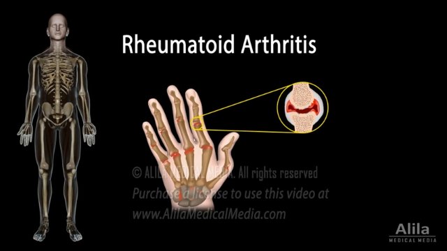 Rheumatoid Arthritis: Clinical Features, ACR/EULAR Criteria & Treatment Options