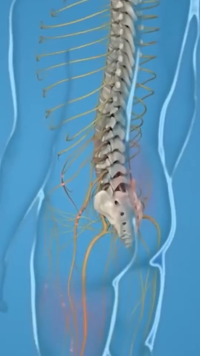 Low Back Pain Essentials: Red Flags, Imaging Guidelines & Stepwise Treatment